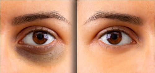 Top 6 kem trị thâm mắt được sử dụng nhiều hiện nay