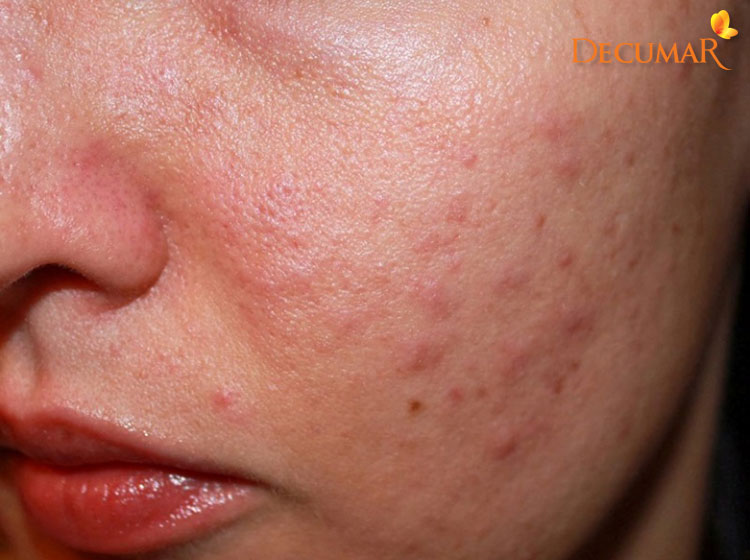 Viêm da mặt nổi mụn – những điều cần biết để phòng tránh và chữa trị